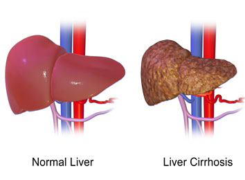 liver-transplant