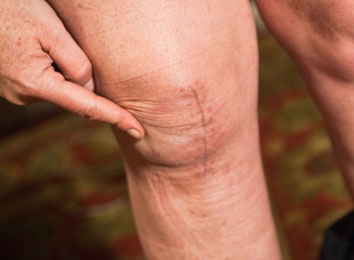 Knee-Replacement-Surgery-in-India