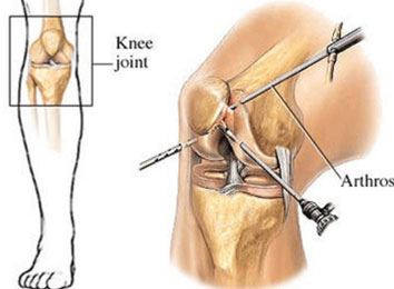 arthroscopic-surgery-in-india