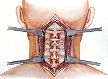cervical-surgery-in-india