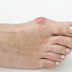 Bunion Surgery in India