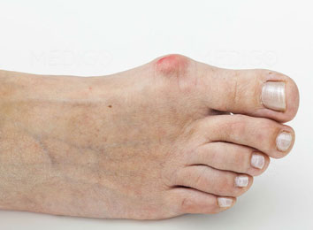 bunion-surgery-in-india