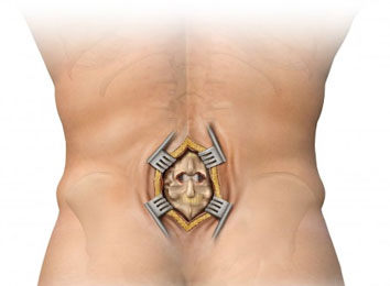 fusion-surgery