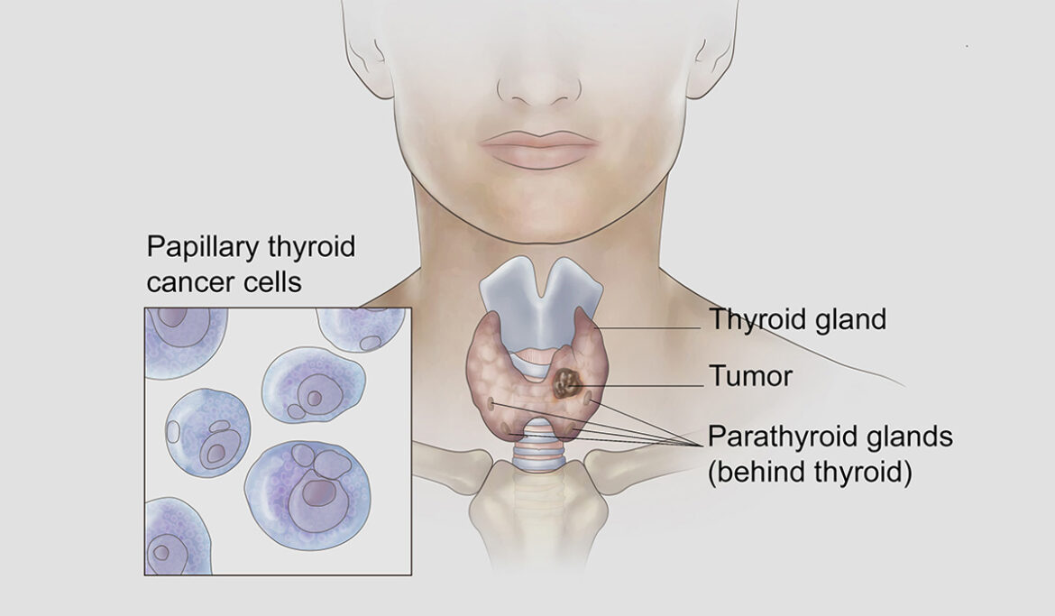 thyroid-cancer-banner