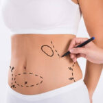 Abdominoplasty(Tummy Tuck) in India