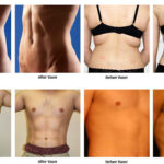 Vaser Liposuction in India