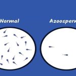 Azoospermia Treatment in India