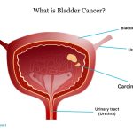 Bladder Cancer in Men: Everything You Need to Know About