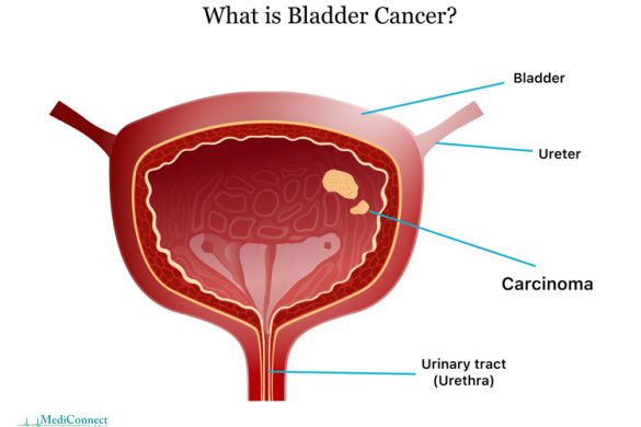 Causes-of-Bladder-Cancer-in-Men