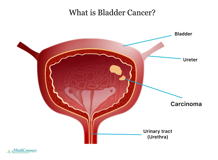 Causes-of-Bladder-Cancer-in-Men